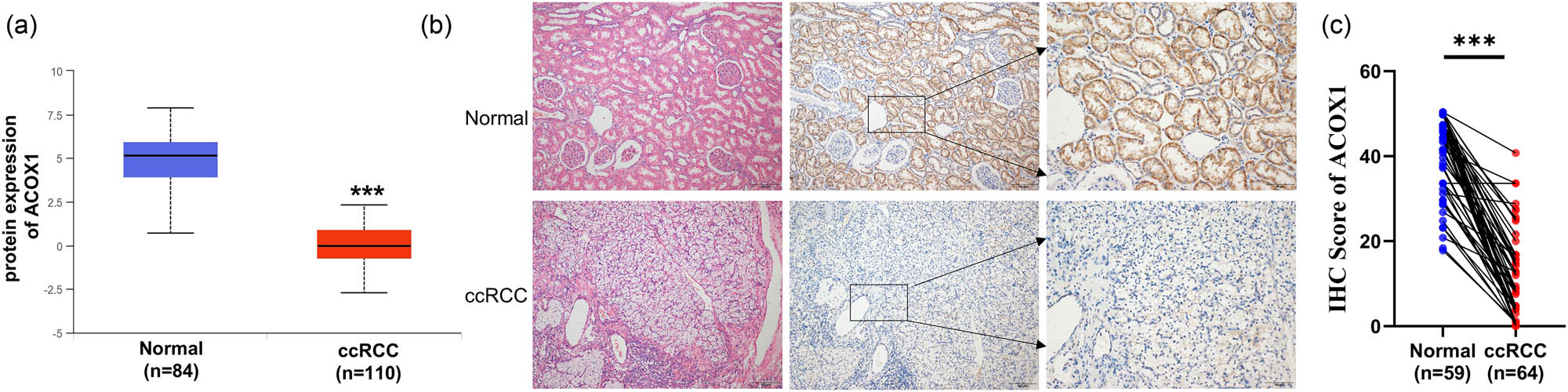 Figure 2 
                  The protein expression level of ACOX1 in ccRCC. (a) Protein expression levels of ACOX1 in 110 ccRCC tissues and 84 normal tissues. (b) Representative HE staining and IHC staining of ACOX1 in ccRCC and normal tissues. (c) Statistical analysis data of IHC staining score.
               