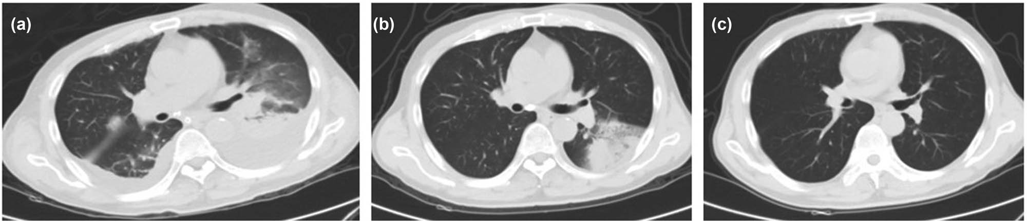 Figure 2 
                  The CT image of case 2. Picture (a) (2020.12.18) is the admission D1, pleural effusion in both lungs, exudation, consolidation, and exudation in the lower lobe of the left lung. (b) Picture (2020.12.29) is the admission D12, Dorsey cyclin D4, the pleural effusion in both lungs was completely absorbed, and the lesions in the lower lobe of the left lung were significantly reduced. Picture (c) (2021.03.11) was reviewed 2 months after discharge, and no obvious lesions were found in both lungs.
               