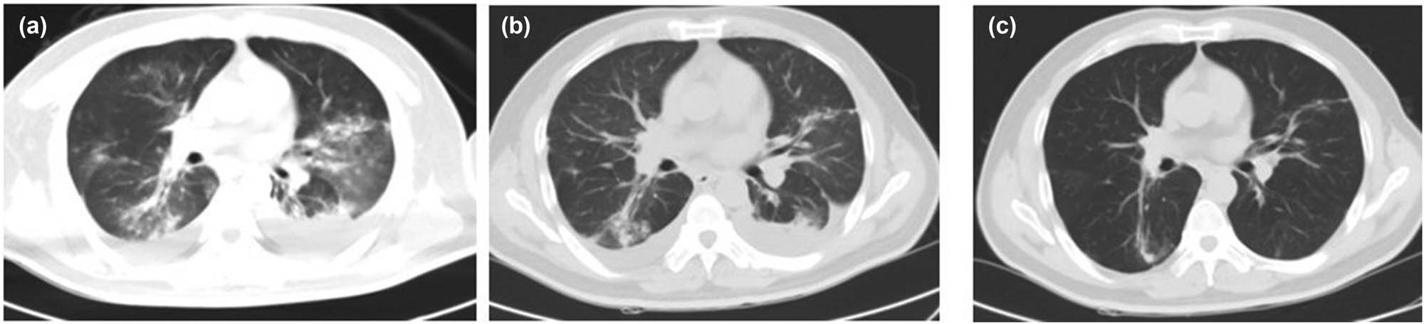 Figure 3 
                  CT image of case 6. Picture (a) (2019.07.23) is admission D10, DOX D9, multiple infectious lesions in both lungs and bilateral pleural effusion. Picture (b) (2019.08.06) is admission D27, DOX sulfur D26, and the infection lesions in both lungs were reduced. Picture (c) (2019.08.27) was re-examined 3 weeks after discharge, and the lesions in both lungs were significantly absorbed compared to before.
               