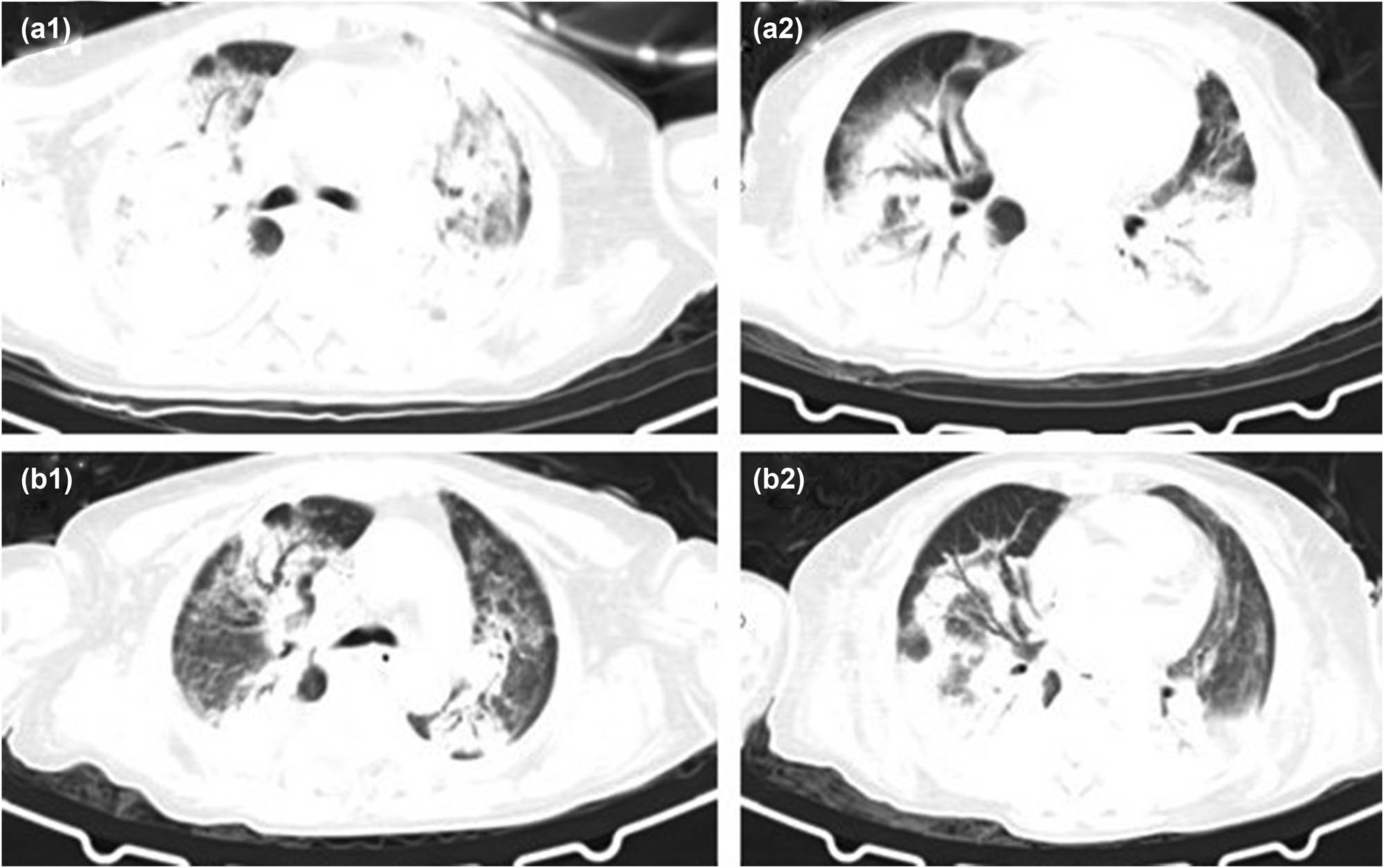 Figure 4 
                  CT images (a1) and (a2) of case 5 (2020.12.26) are on the first day of admission, with multiple patches and patchy slightly high-density shadows and consolidation shadows in both lungs, with air bronchus sign, and bilateral pleural effusion. (b1) and (b2) (2021.01.11) show the admission D16, DOX D13, and the bilateral lung infection lesions are less than before.
               