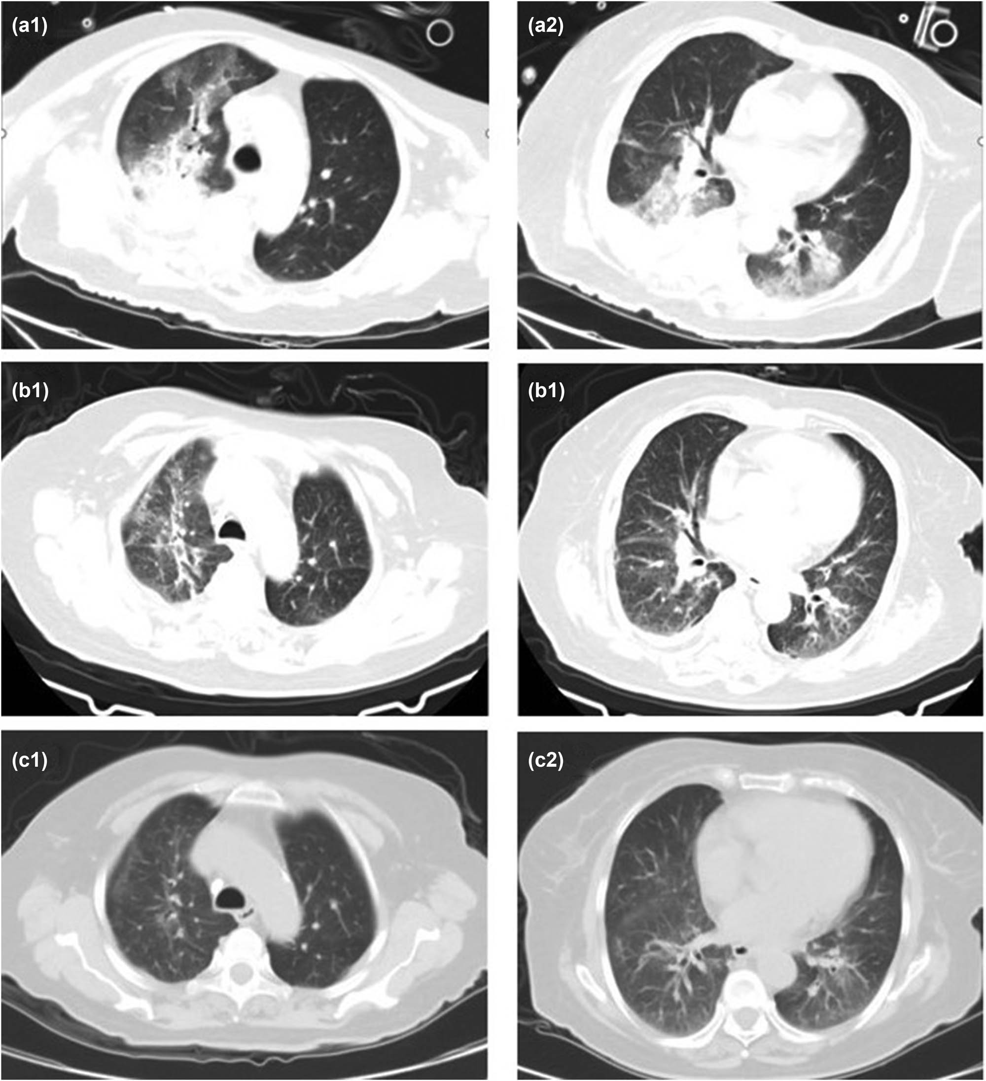 Figure 5 
                  CT images (a1) and (a2) of case 7 (2021. 02.23) are admission D8, DOX D1, bilateral lung infection. (b1), (b2) (2021.03.04) are admission D18, DOX D11, and the bilateral lung infection lesions were slightly reduced. Pictures (c1) and (c2) (2021.03.27) were re-examined 2 weeks after discharge, and the bilateral lung lesions were significantly absorbed.
               