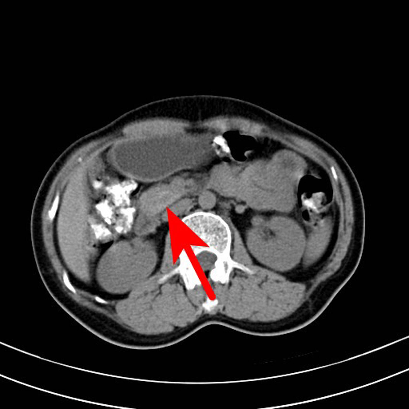 Figure 1 
               CT scan of the abdomen of the patient. The arrow points to a nodular slightly high-density shadow on the head of the pancreas, with a maximum transverse diameter of about 19 mm and a clear boundary, and a small saccular low-density shadow and a punctate calcification shadow.
            