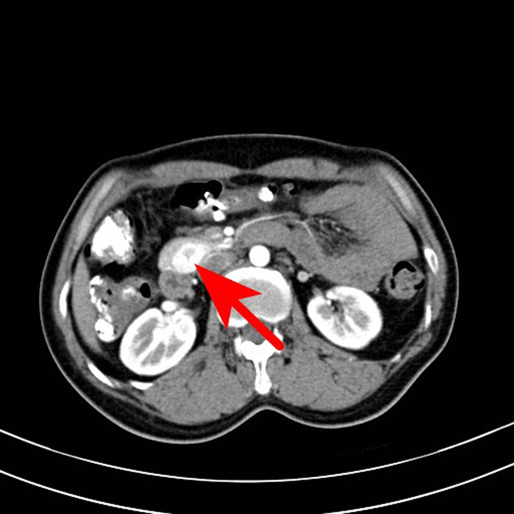 Figure 3 
               Transverse axial scan of the arterial phase. The lesions showed uneven enhancement, the highest CT value reached 192 HU, and the low-density areas were not enhanced.
            