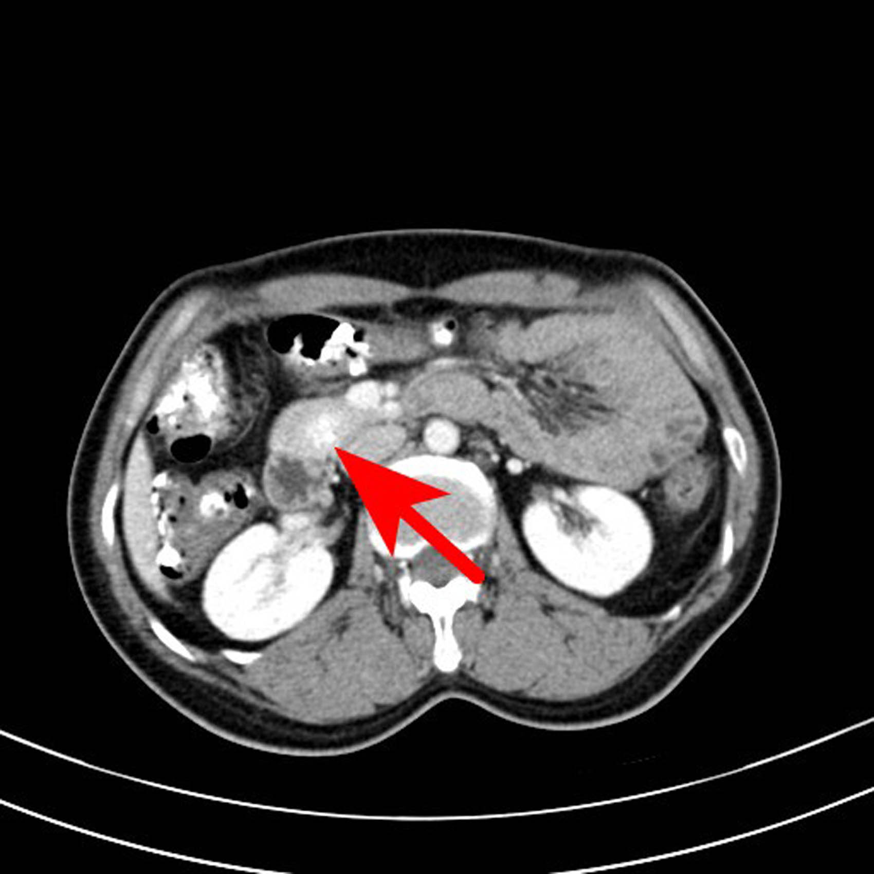 Figure 5 
               Transverse axial scan of the portal venous phase. The lesion was still high-density with CT value of 174 HU.
            