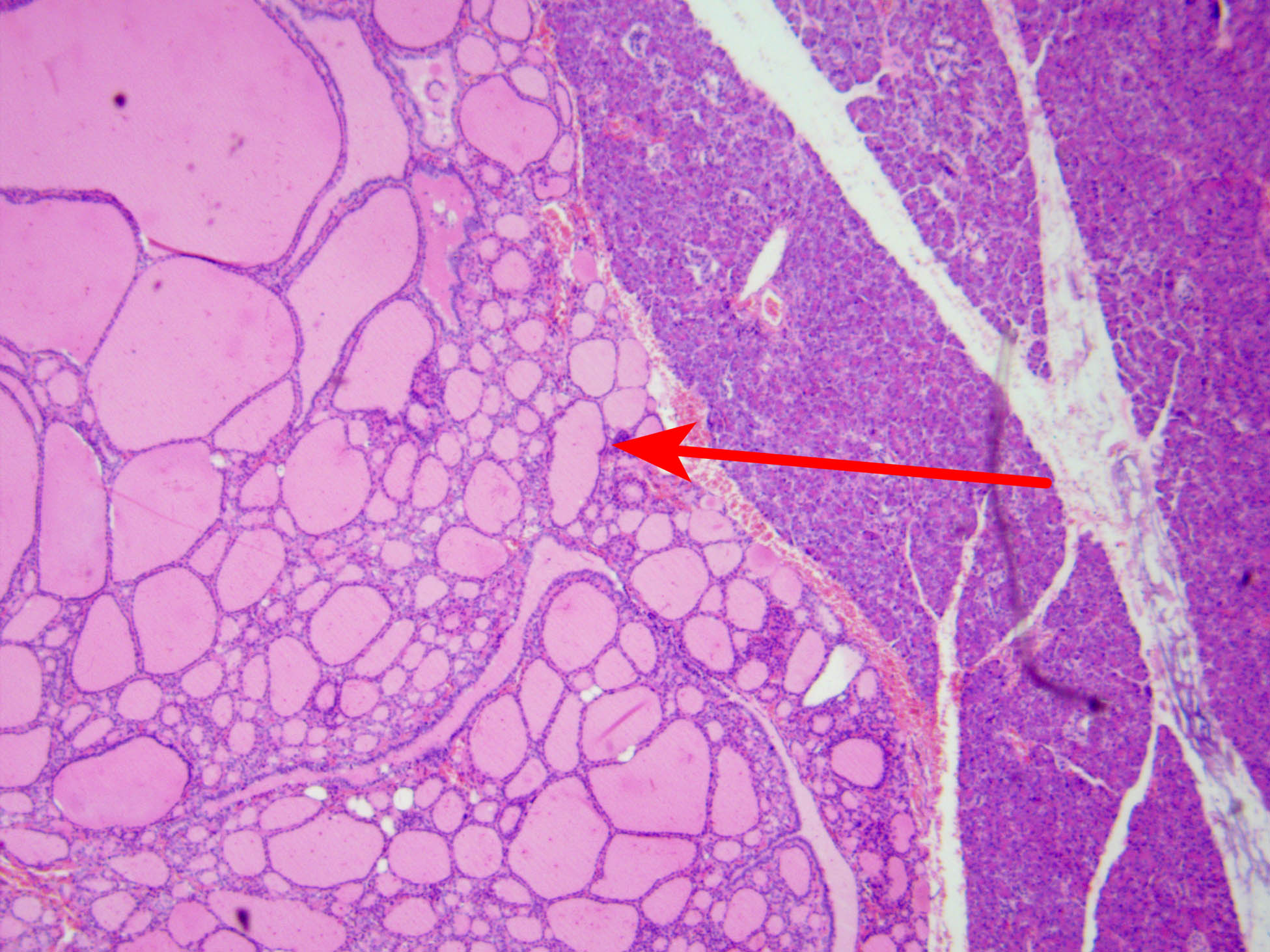 Figure 6 
               Pathological findings: HE staining, 40×; under the microscope, thyroid tissues were observed within the pancreatic tissues, approximately 2.5 cm × 2.0 cm × 1.6 cm in size, with follicles of varying sizes and mild cell morphology.
            