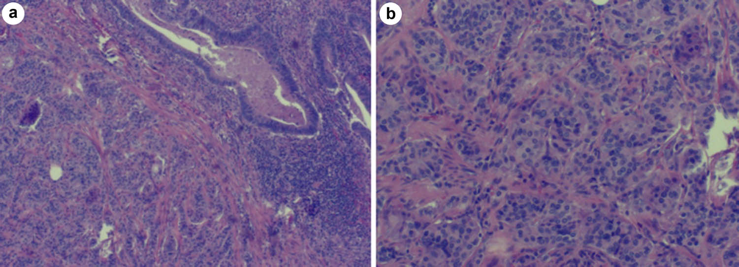Figure 1 
                  Adenocarcinoma is seen in the upper right corner and NET-G1 in the lower left corner, which are independent with no migration (a, 4 × 10); NET-G1 is observed in small nest, strip, round, or oval shape with uniform size (b, 10 × 10).
               