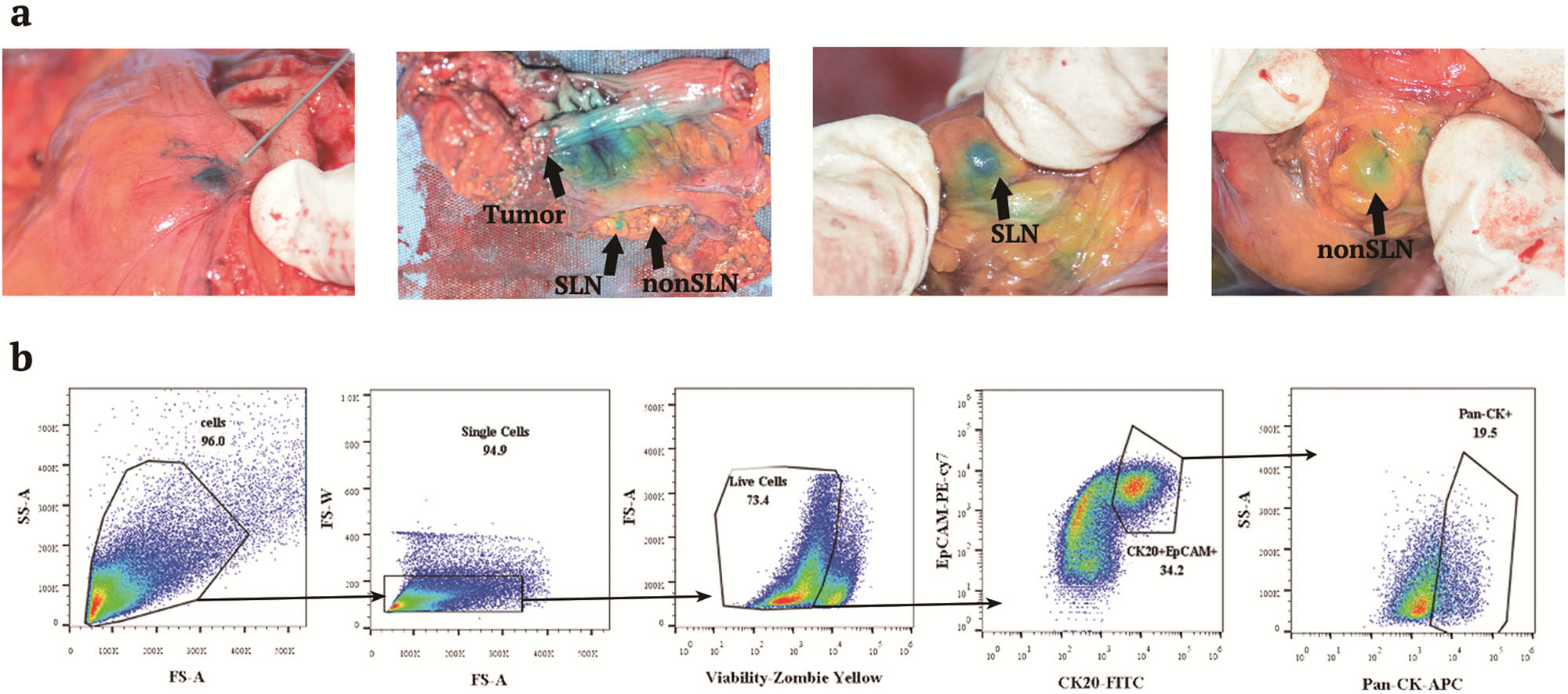 Figure 2
Identification of SLN from CRC patients and FCM gating strategy of tumor cells in LN. (a) During colorectal surgery, patent blue dye was injected around the primary tumor within about 5 min. The first blue-drained LN was SLN, and the next blue LN was non-SLN. (b) The gating strategy of tumor cells in LN: In the first step, cell debris is gated off by FS-A versus SS-A axis. Single cells are gated in from cells in the second. Live cells are gradually gated depending on viability-FMO control (viability-fluorescence minus One, sample stained with all antibodies except viability zombie yellow). From the live cell gate, double molecular positive cells were gated on a CK20 versus EpCAM plot based on the CK20-FMO control and EpCAM-FMO control gating location, respectively. From this double molecular positive population, the frequency of Pan-CK-positive cells was quantified by Pan-CK-FMO control, and the CK20-EpCAM-Pan-CK triple-positive cells represent the tumor cells among the whole population of cells.