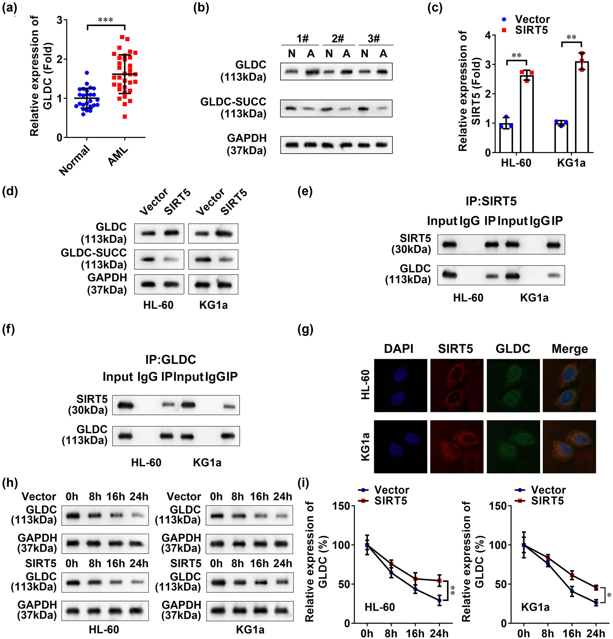 Figure 3
SIRT5 modified GLDC by succinylation. (a) mRNA levels of GLDC in clinical samples of AML were detected by qRT-PCR. (b) Protein expression and succinylation levels of GLDC in clinical samples of AML were detected by western blot and the exemplary western blot images are shown (three samples). (c) Overexpression efficiency of SIRT5 was detected by RT-qPCR. (d) Protein expression levels of GLDC and GLDC-SUCC after SIRT5 overexpression were detected by western blot. (e and f) Co-IP and western blot analysis were used to evaluate the interaction between GLDC and SIRT5. (g) IF staining was used to evaluate the binding between SIRT5 and GLDC. (h and i) Protein stability of GLDC in the SIRT5 overexpressed AML cell lines was detected by western blot. ***p < 0.001.