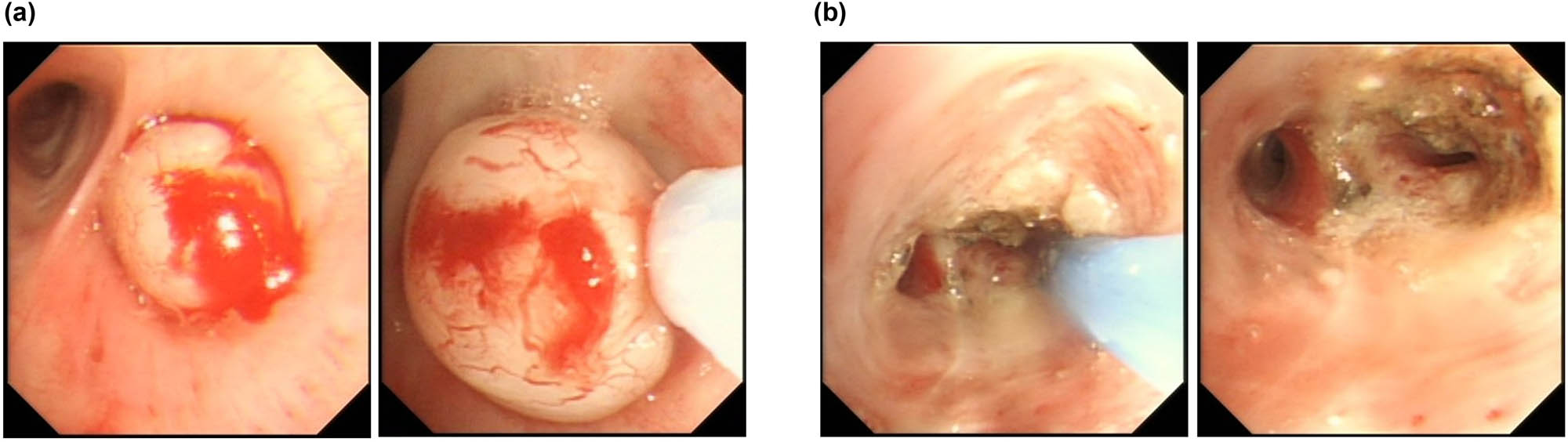 Figure 2
Bronchoscopic appearance (a) before and (b) after minimally invasive intervention.