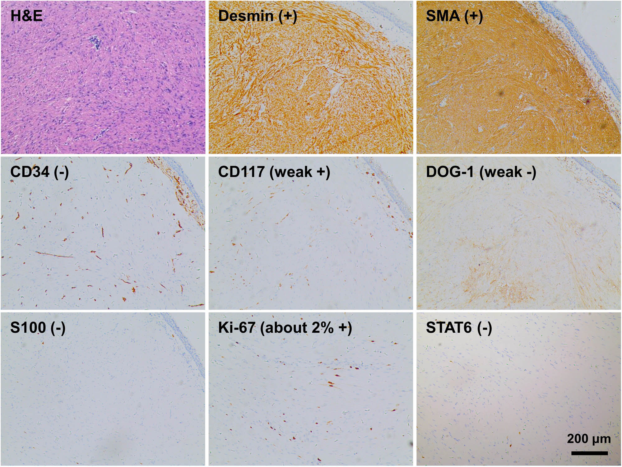 Figure 3
Diagnostic tumor pathology (magnification: 10×).