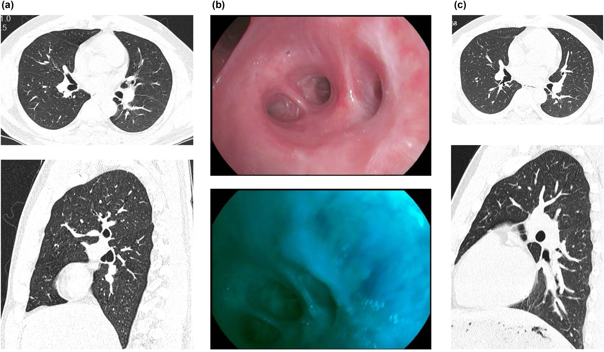 Figure 4
Postoperative follow-up review. (a) A chest CT scan at 3 weeks postoperatively showed a soft tissue nodule in the right bronchus, but there was no significant change compared to the previous examination. (b) Bronchoscopy performed at 7 weeks postoperatively showed localized mucosal whitening and fluorescence defects at the right lower lobe bronchial opening, but the airway remained patent. (c) A chest CT scan 6 months postoperatively showed no signs of tumor recurrence.