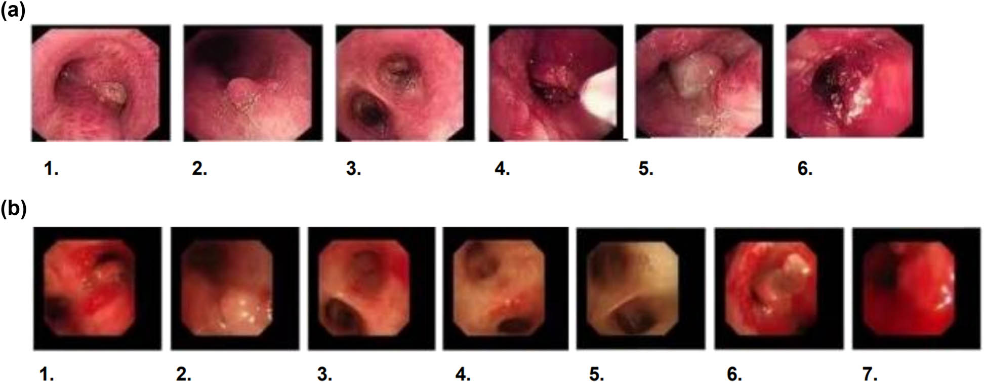 Figure 2
(a) The initial bronchoscopy reveals lesions in both the left and right bronchi and that electrocautery was performed. 1. Tracheal carina, 2. Left Main Bronchus, 3. Distal Left Main Bronchus, 4. Electrocautery in Progress, 5. Distal Right Main Bronchus, 6. Right Main Bronchus Opening Under Treatment. (b) The follow-up bronchoscopy shows that despite the intervention, there are still lesions present. 1. Tracheal carina, 2. Left Main Bronchus, 3. Distal Left Main Bronchus, 4. Left Upper Lobe Bronchus Opening, 5. Left Lower Lobe Bronchus Opening, 6. Right Main Bronchus Opening, 7. Right Main Bronchus Opening Under Treatment.