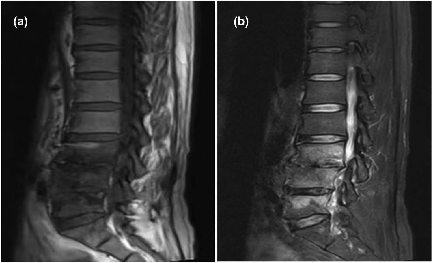 Figure 3
Lumbar spine MRI indicates abnormal signal intensity in the L3–L5 vertebral bodies with low signal on T1-weighted images (a) and high signal on T2-weighted images (b), suggestive of an infectious lesion.