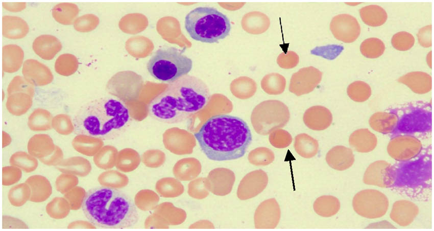 Figure 1 
               Peripheral blood smear (arrows show small spherical red blood cells) (HE staining).
            