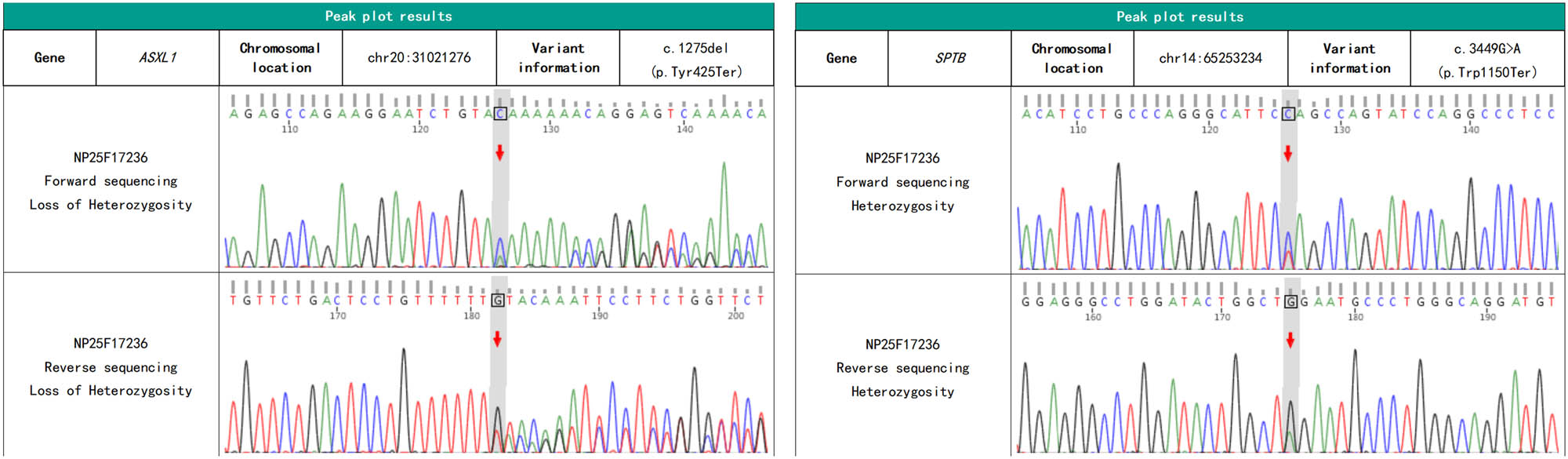 Figure 2 
               Sanger sequencing results of SPTB and ASXL1 genes (the overlapping peaks caused by insertion mutation in the sequencing signal during unidirectional sequencing precisely indicate that a base is missing here).
            