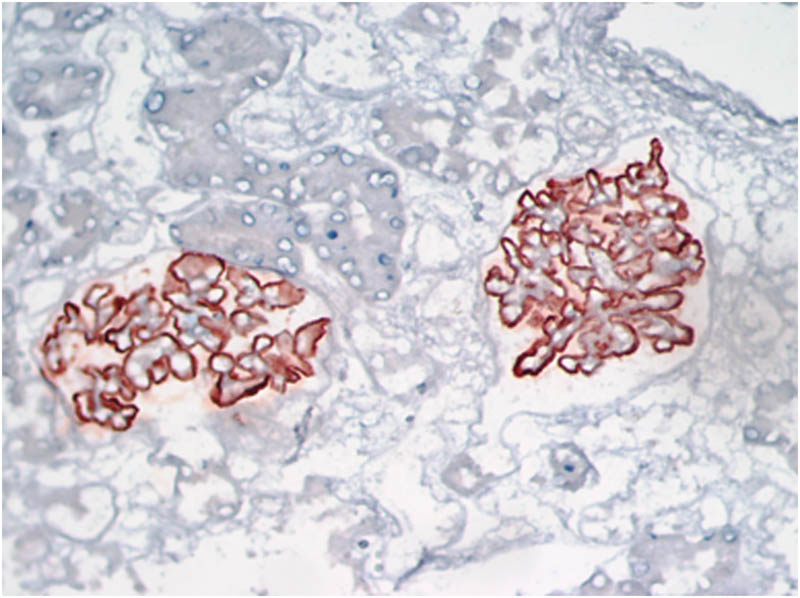 Figure 3
Immunohistochemical analysis of the kidney reveals PLA2R++ (400×).