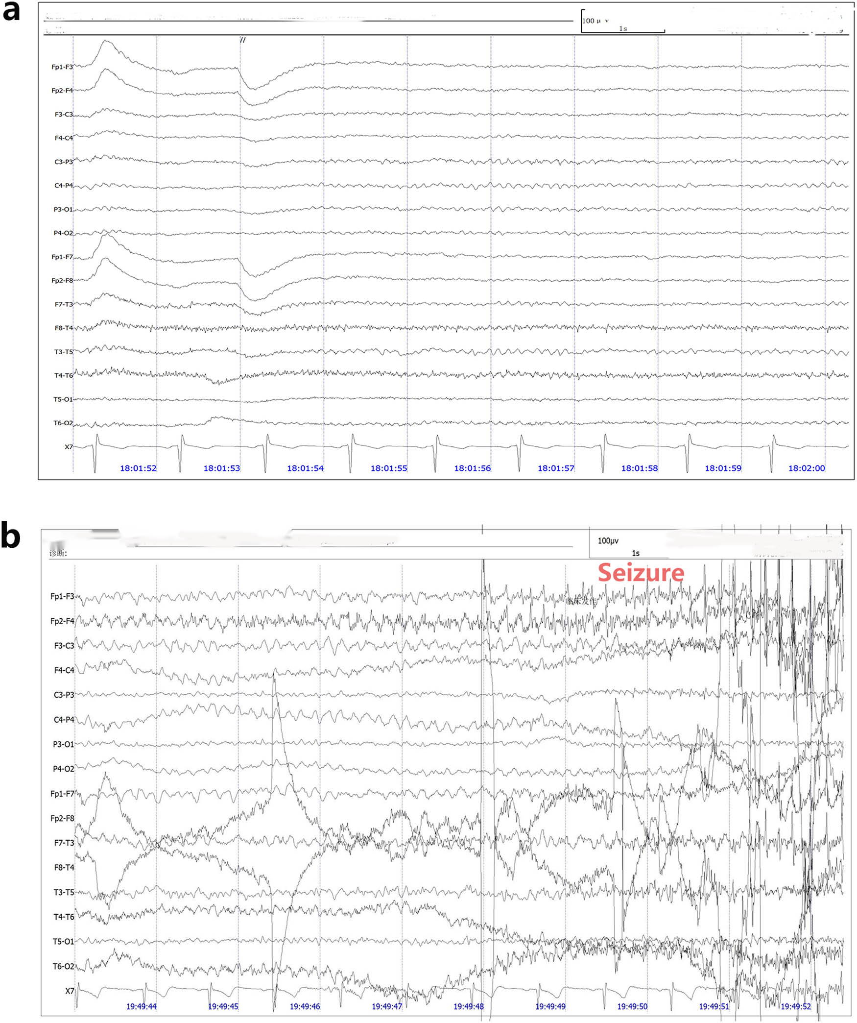 Figure 2
EEG of the patient. (a) An electroencephalogram showing normal background activity with no epileptiform patterns. (b) Video EEG showed that slow waves appeared first in temporal lobe leads, and then spike slow waves appeared in full leads with a lot of EMG artifacts.