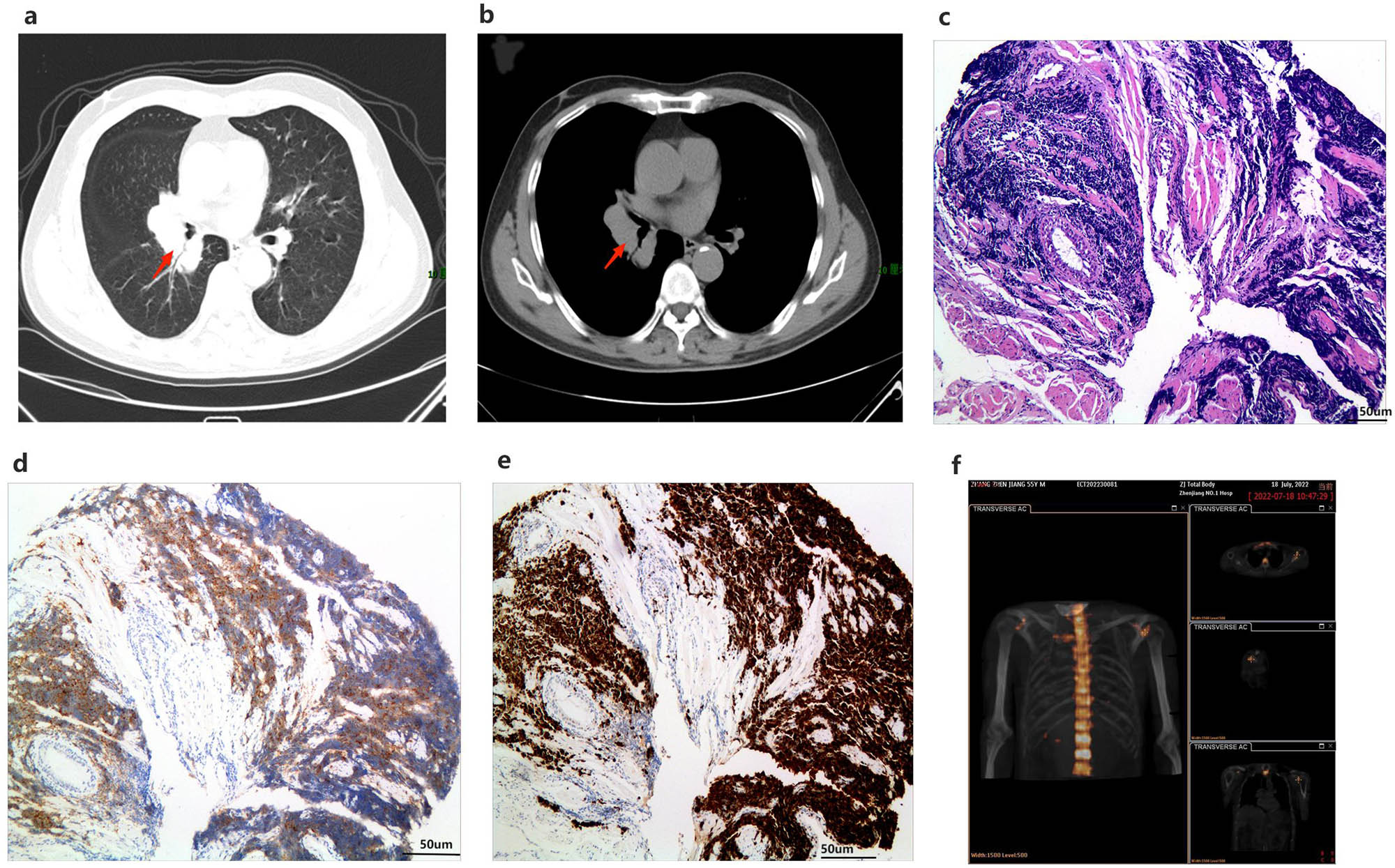 Figure 4
Patient’s chest CT, pathological examination, and bone scan. (a) and (b) Patient’s chest CT (the arrow points to the tumor location). (c)–(e) Pathological examination of lung bronchoscope indicates small cell lung cancer ((c) original magnification ×200). Immunohistochemical examination showed that Syn (d) and Ki67 (e) were positive (original magnification ×200). (f) Bone scan showed that the radioactive uptake of the left shoulder joint was significantly higher than that of the right.