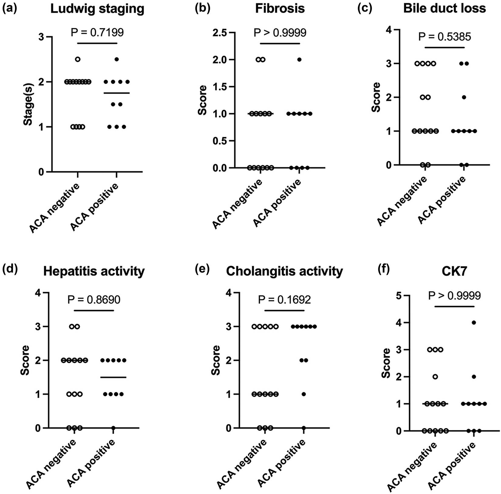 Figure 2
Comparison of Ludwig stages and Nakanuma scales of ALBI grade 1. (a) Ludwig stage. (b–e) Nakanuma scales. (f) CK7 score. Mann–Whitney U test was used.