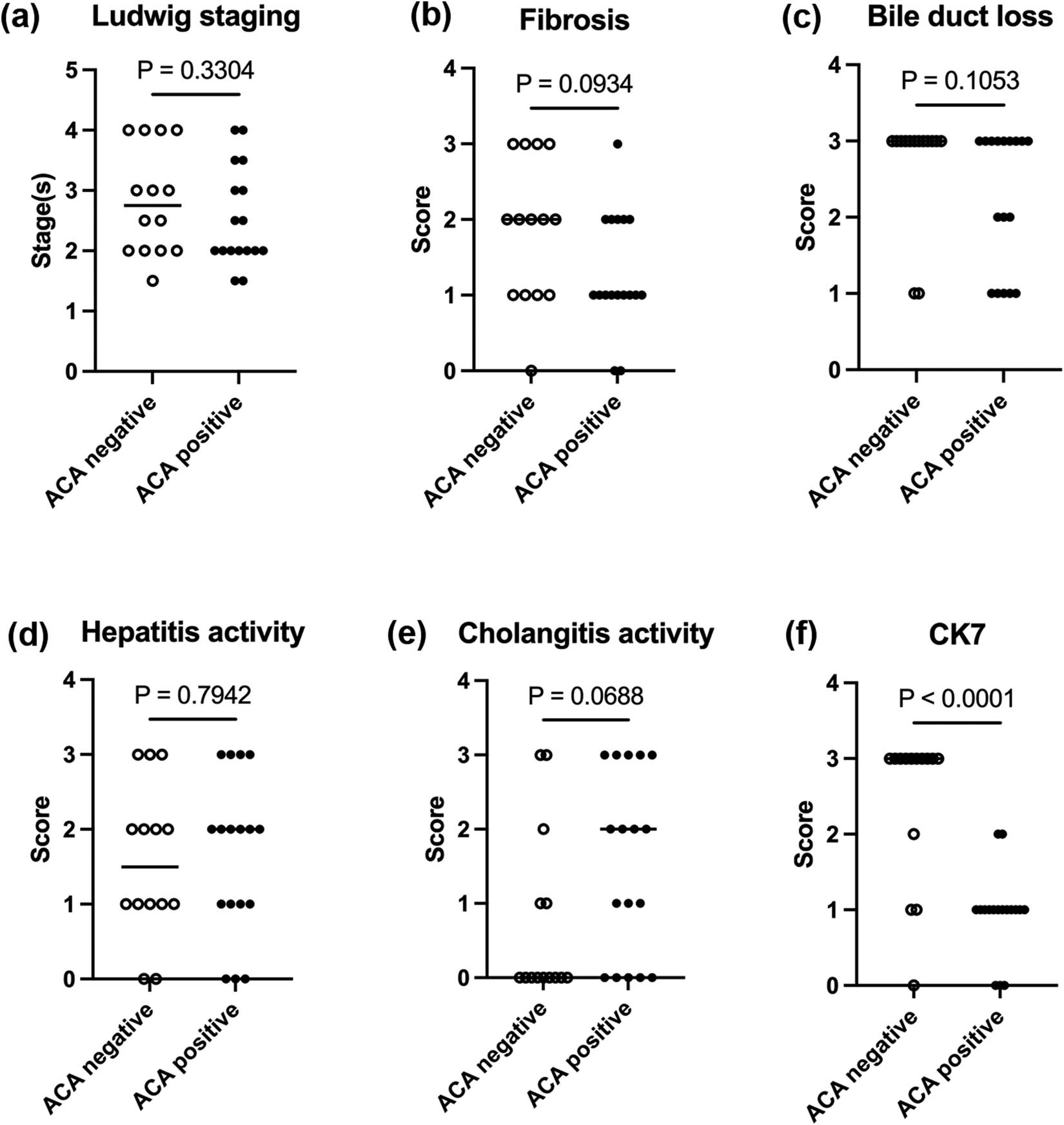 Figure 3
Comparison of Ludwig stages and Nakanuma scales of ALBI grade 2&3. (a) Ludwig stage. (b–e) Nakanuma scales. (f) CK7 score. Mann–Whitney U test was used.