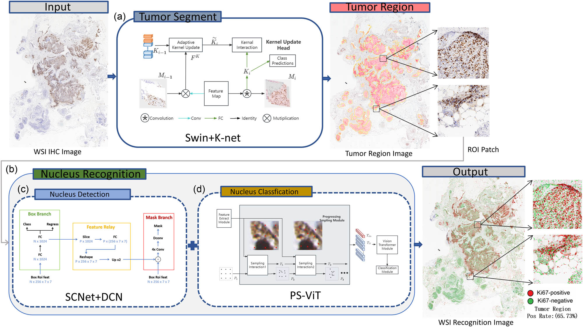Figure 2 
                  Overall framework of the WSI quantitative analysis system for breast Ki67 pathology image. ROI refers to the region of interest. This term is used to describe the parts of pathological images that are important for diagnosis and analysis. ROI patch refers to a small area segmented from the WSI image that contains important diagnosis information. Swin+K-Net, SCNet+DCN, and PS-ViT are all deep learning methods for specific tasks. (a) Tumor segment. (b) Nucleus recognition. (c) Nucleus detection. (d) Nucleus classification.
               
