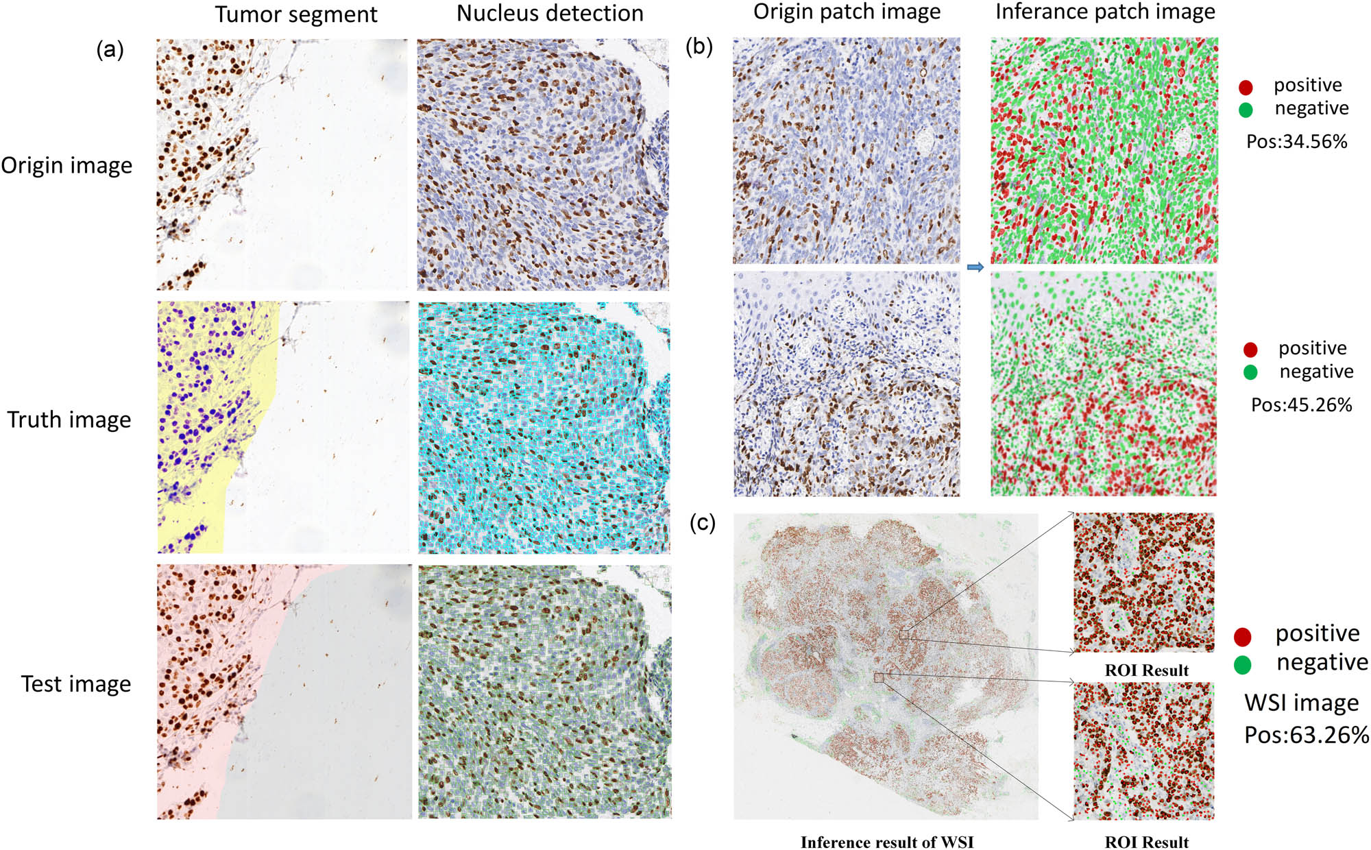 Figure 5 
                  Visualized inference results of breast Ki67 analysis system. (a) The visualization of the inference results of tumor segment and nucleus detection in patch. (b) The visualization of the inference of nucleus recognition in patch. (c) The visualization of the WSI inference of the breast Ki67 case.
               