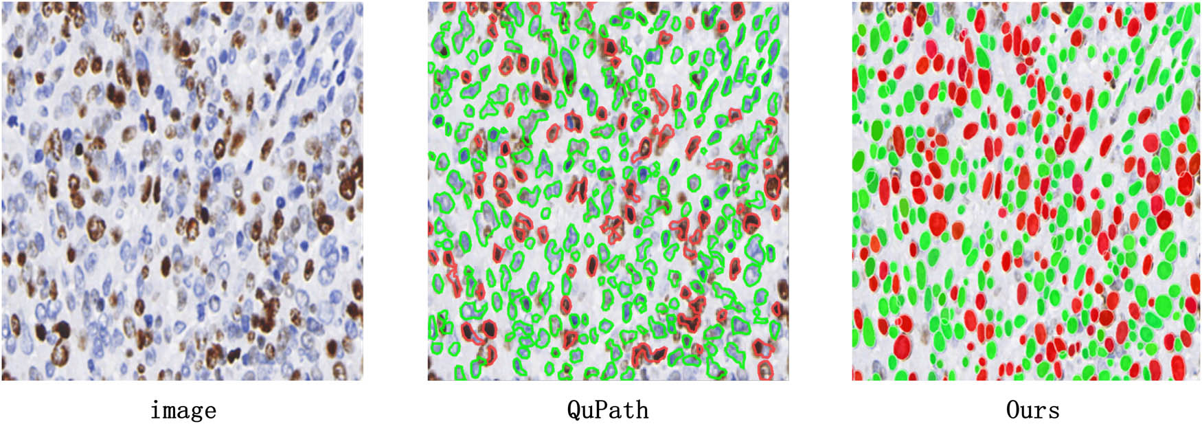 Figure 7 
                  Comparison of QuPath detection results. There are 172 positive cells in the raw image. Only 76 positive cells are detected by QuPath, while our method is able to accurately identify 154 positive cells. Compared to the QuPath, our method performs twice as well. The detection accuracy of our method is 89.5%.
               