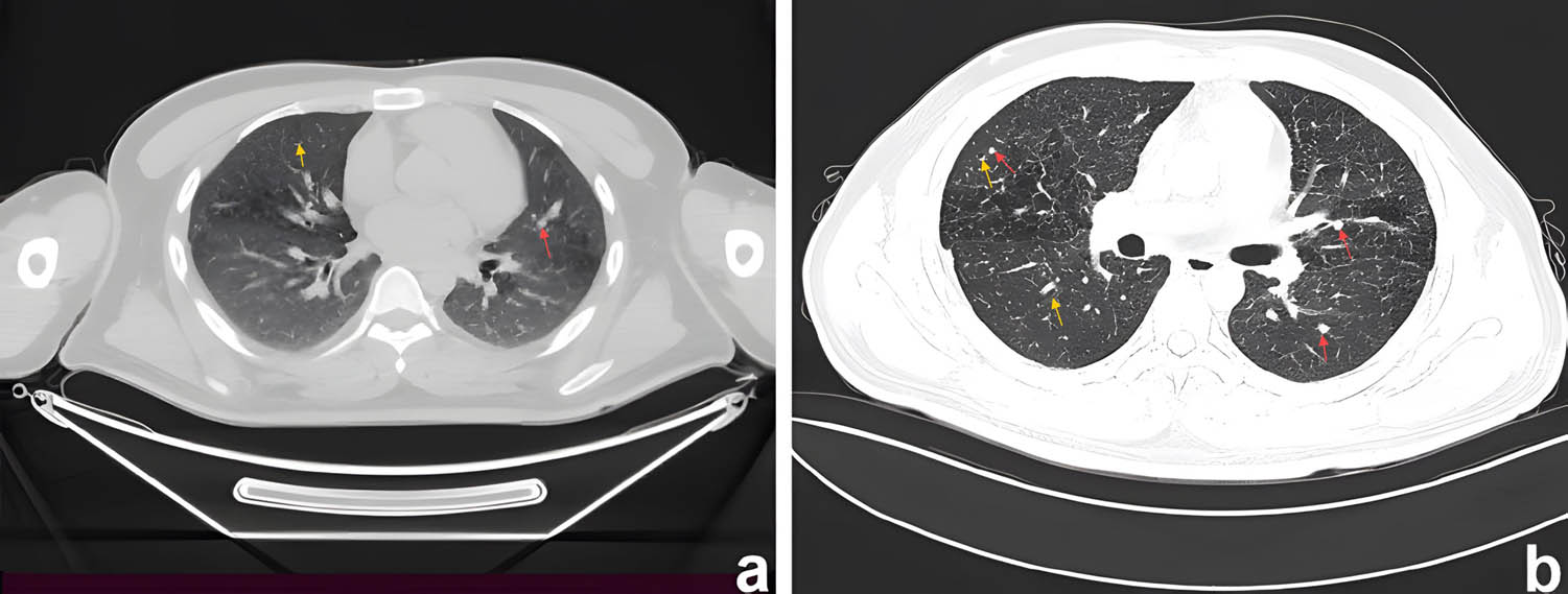 Figure 6 
               Computed tomography of chest showing nodules (red arrows)/cyst (yellow arrows) in both lungs. (a) CT axial view shows cysts of varying sizes in the upper lobes of both lungs. (b) Thin-section CT showed nodules with unclear boundaries, mainly located in the middle lobes of both lungs. Some nodules had clear centres, indicating that they would become cystic.
            