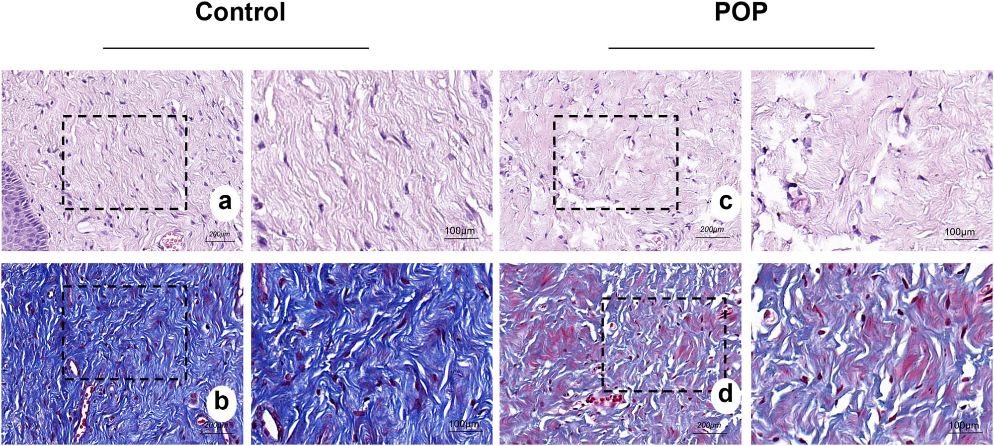 Figure 1
HE staining and Masson staining of the tissue of the anterior vaginal wall: (a) and (b) anterior vaginal wall of the control group; (c) and (d) anterior vaginal wall of the POP group. Collagen fibers were pink in HE staining and blue in Masson staining. (a)–(d) magnification 50×.