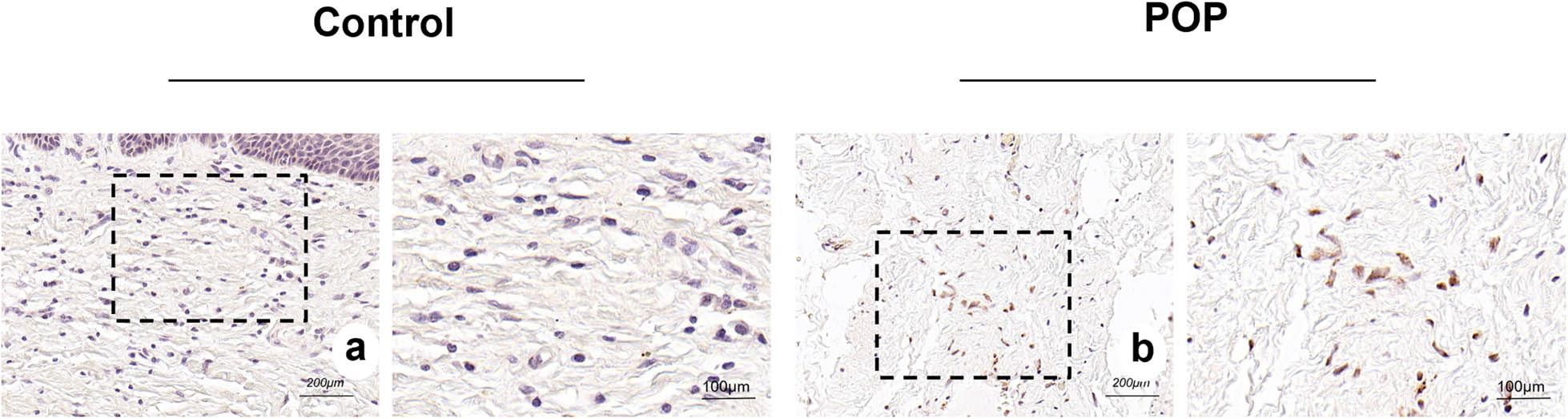 Figure 2
(a) and (b) TUNEL cell apoptosis staining of the tissue of the anterior vaginal wall in the control and POP groups, respectively. The brownish yellow granules are nuclei of the apoptosis cells. (a) and (b) magnification 50×.
