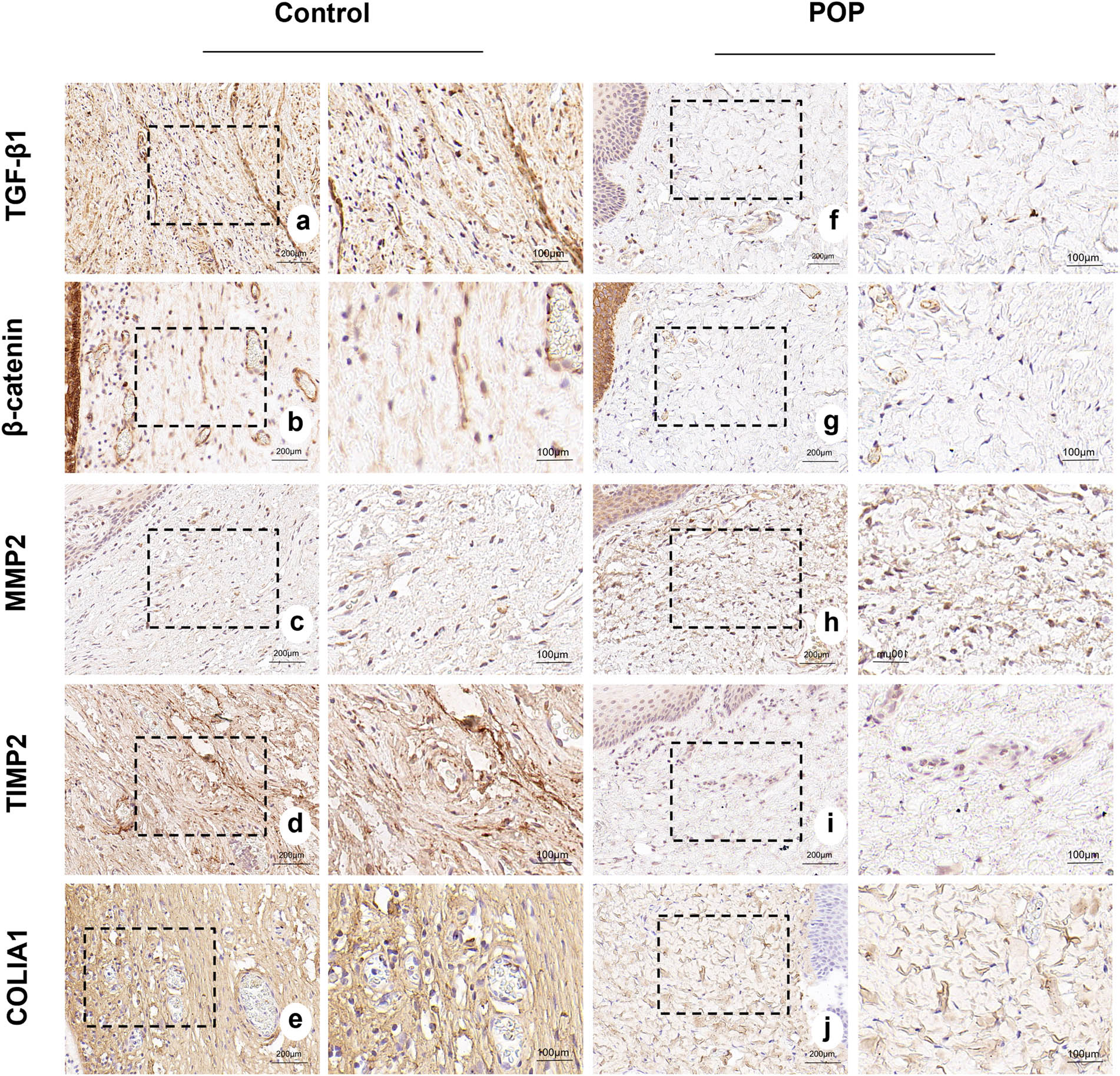 Figure 3
(a)–(e) Expression of TGF-β1, β-catenin, MMP2, TIMP2, and COL1A1 in the anterior vaginal wall tissues of patients in the control group. (f)–(j) Expression of TGF-β1, β-catenin, MMP2, TIMP2, and COL1A1 in the anterior vaginal wall tissues of patients in the POP group, respectively. (a)–(j) magnification 50×.