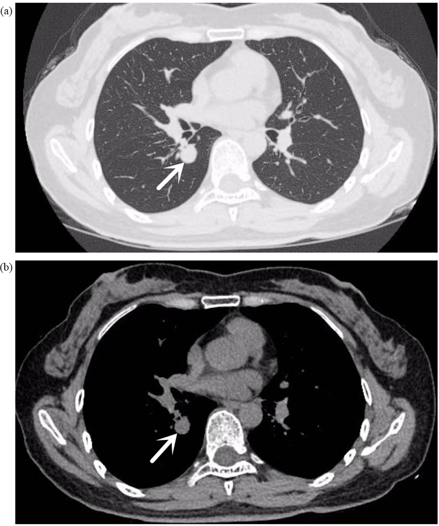 Figure 1 
                  (a) (Lung window), (b) (mediastinal window) chest plain CT: small nodules in the dorsal segment of the right lower lobe, with smooth margins. The arrow indicates the location of the tumor.
               