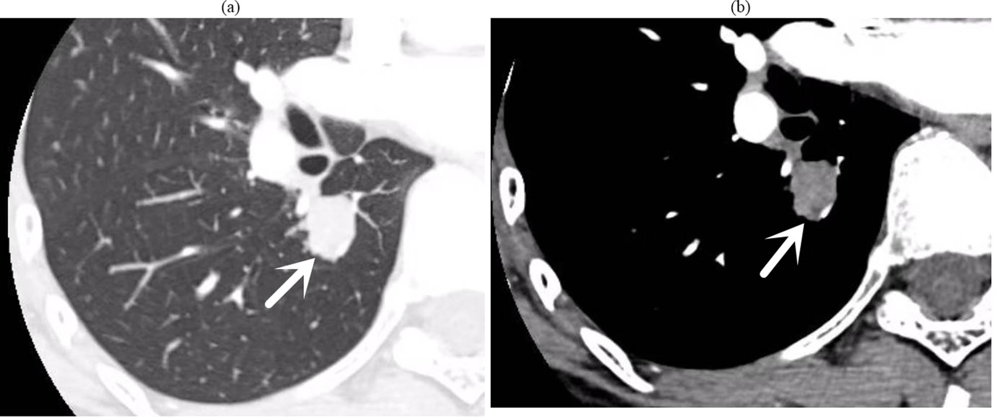 Figure 2 
                  (a) (Lung window), (b) (mediastinal window) chest target-enhanced CT: small nodules in the dorsal segment of the right lower lobe, with punctate calcifications visible within it, surrounded by multiple punctate and nodular shadows; nodular growth was seen in the dorsal segment of the bronchus.
               