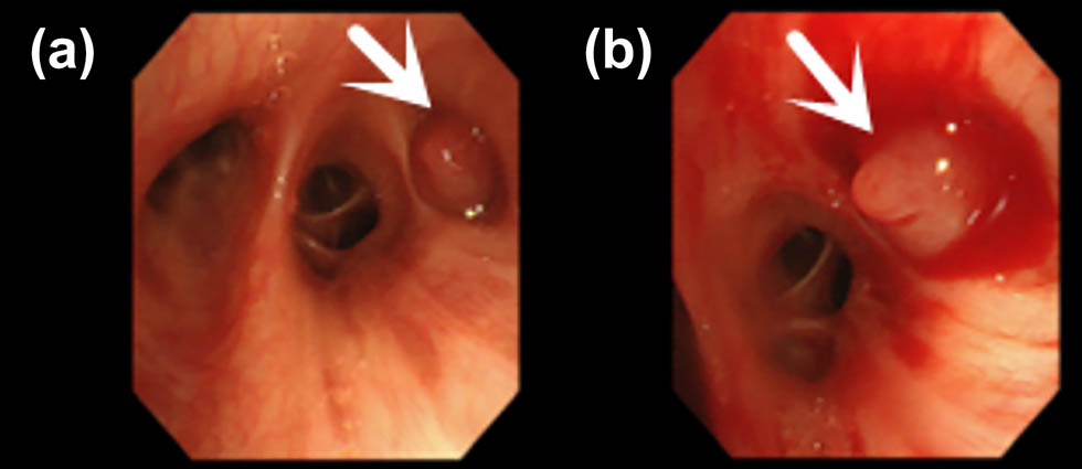 Figure 3 
                  (a) Bronchoscopy reveals smooth cystic neoplasms obstructing the orifice of the dorsal segment of the right lower lobe. (b) Bronchoscopy shows neoplasms at the orifice of the dorsal segment of the right lower lobe, swinging with respiration and prone to bleeding upon touch.
               