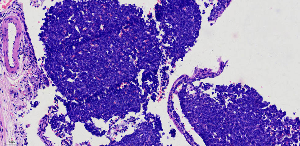 Figure 4 
                  Aggregation of short spindle-shaped cells under a microscope. H&E staining, 20× magnification image.
               