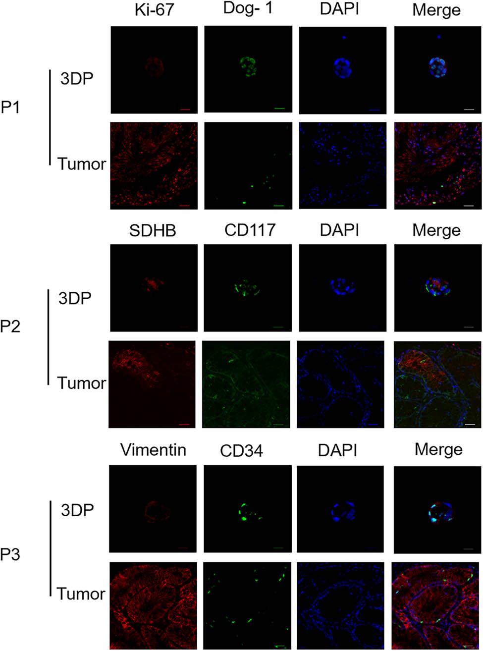 Figure 4
Immunofluorescence of 3DP tumor models and primary tumor tissues.