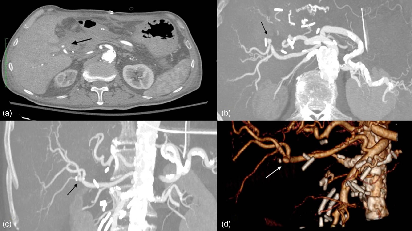 Figure 2
CTA. Arrows show hepatic artery pseudoaneurysm: (a) axial view, (b) axial MPR, (c) coronal MPR, (d) 3d reconstruction.