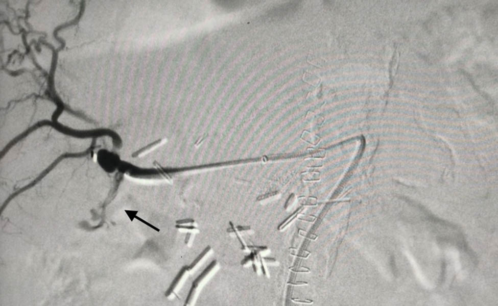 Figure 3
Intra-op angiography. The arrow shows the contrast extravagation.