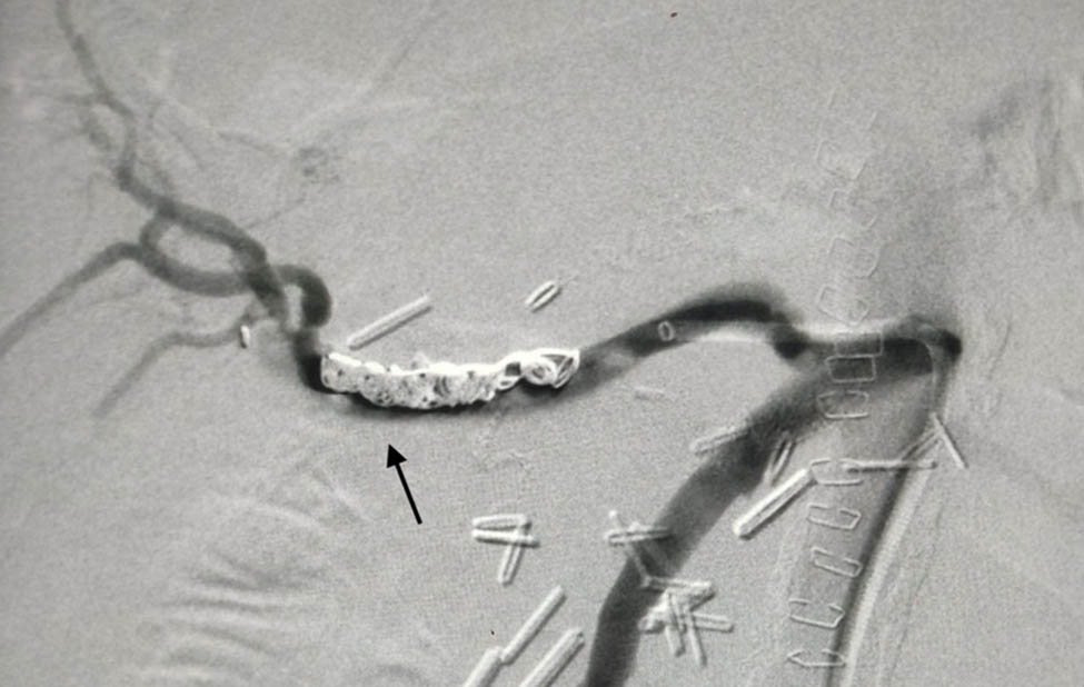 Figure 4
Final angiography with coils in place. No hemorrhage identified. Arrow indicates the previous site of extravagation.