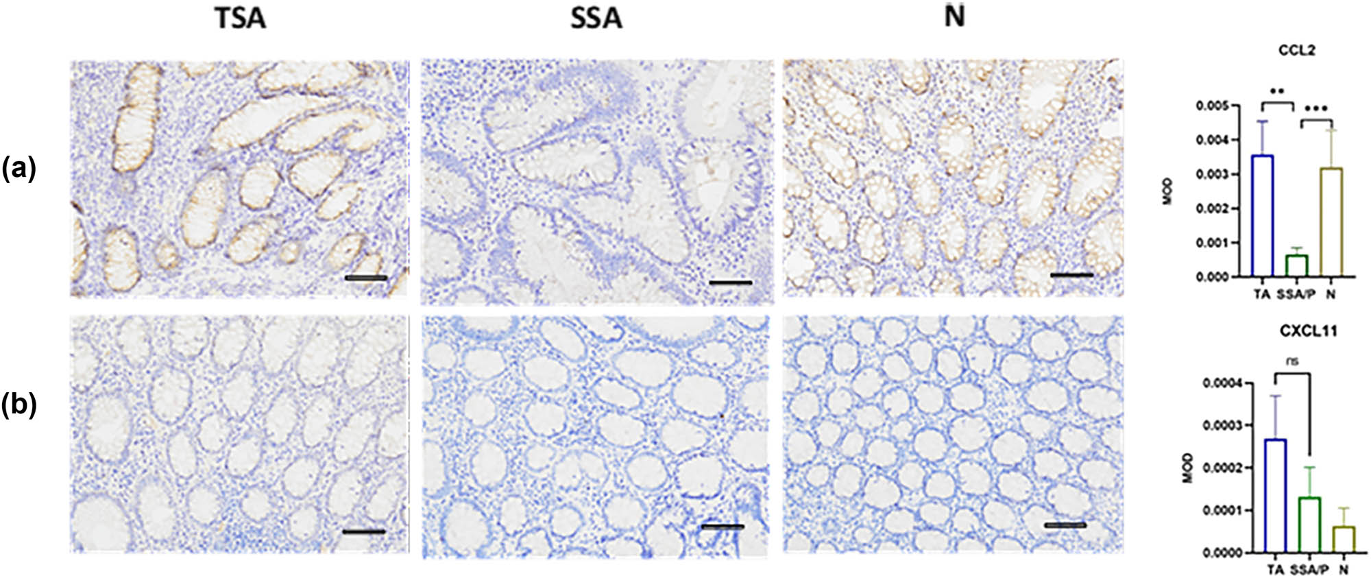 Figure 6
Expression of CCL2 (a) and CXCL11 (b) in TSA, normal tissues (N), and SSA. Scale bar: 200×.