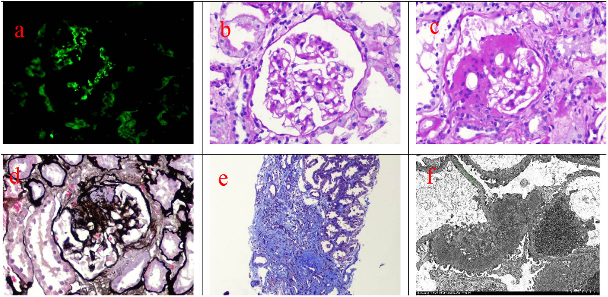 Figure 1 
               Renal pathological results of this patient. (a) Immunofluorescence staining of biopsied renal tissue showed the positive IgA deposition in the mesangial area (×400). (b) PAS staining exhibited mild mesangial proliferation in the glomerulus (×400). (c) PAS staining showed afferent and efferent arteriolar hyalinosis (×400). (d) PASM staining showed the glomeruli with segmental glomerulosclerosis (×400). (e) Masson trichrome staining showed obvious tubulointerstitial fibrosis (blue stained, ×100). (f) Transmission electron microscope observed electron-dense mesangial deposits (×15,00).
            
