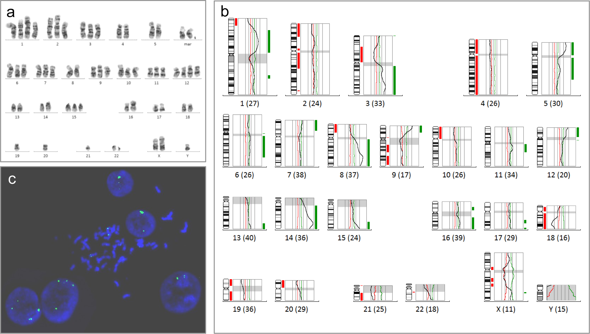 Figure 1 Genetic alterations in FaDu cell line. a: Karyotype analysis by GTG-banding indicated a highly complex karyotype with numerous marker chromosomes and numerous translocation chromosomes in FaDu metaphase spreads. b: CGH profile of FaDu cell line shows high-level amplifications of 3q25.3q27, 8q22q24.2 and 14q24.3qter, gains of 1p13.1p33, 1q25.3, 3q, 5p, 5q11.2q31.1, 6q12q24, 7p14pter, 8q, 9p21pter, 11q11.1q14.1, 12p, 13q32qter, 14, 15q24qter, 16p11.1, 16q, 17q21.3q22, and 17q25, and losses of 1p35pter, 2p11.2, 2p21pter, 2q11.2q22, 3p11.1p21.3, 4, 8p21.2pter, 9q13q21.3, 9q32q34.3, 10p, 18p11.2, 18q, 19, 20p and 21. Bars to the left (red) and right (green) of each chromosome indicate losses and gains, respectively. The numbers in brackets represent the number of metaphase chromosomes investigated for analysis shown in the profile. c: FISH analysis of interphase nuclei and metaphase spread with a SEC62-specific BAC probe (green). The insert shows nuclei with two and four SEC62 signals, respectively, together with an amplification of SEC62 (green: SEC62, blue: DAPI counterstain, magnification 60x).
