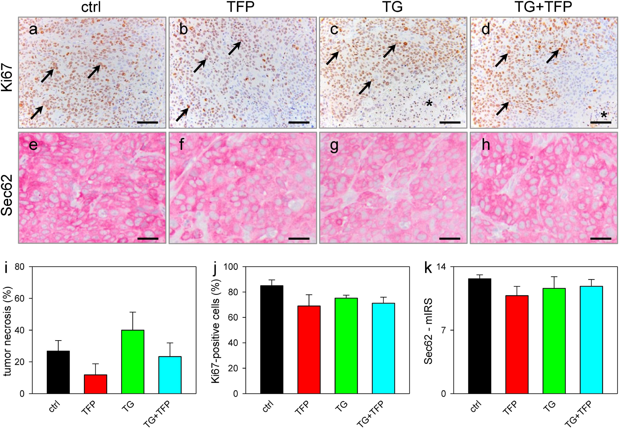 Figure 5 Immunohistochemical stainings of FaDu cell tumors 35 days after inoculation into the flank of athymic mice treated with the vehicle (ctrl, n = 6; a,e), 0.5 mg/kg Trifluoperazine (TFP, n = 6; b,f), 1.6 mg/kg Thapsigargin (TG, n = 6; c,g) or with both substances (TG+TFP, n = 6; d,h). The immunohistochemical detection of proliferating Ki67-positive cells (in %, arrows) showed an increased proliferation rate in the tumors of vehicle treated mice compared to the tumors of the other treatment groups (a-d, j). Note, that the central necrosis (in %, asterisk) in the tumors was markedly reduced in the Trifluoperazine-treated animals compared to the Thapsigargin-treated animals (i). Analyzing the Sec62-mIRS (e-h, k), we found slightly reduced staining intensities in the tumors of the treatment groups compared to the tumors of the vehicle-treated group. Scale bars: 80 μm (a-d); 30 μm (e-h). Means ± SEM.