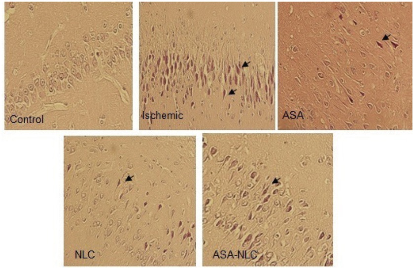 Figure 7 Slices of brain tissue stained by H&E. In the ischemic group, necrosis, foamy cytoplasm, shrunken neurons, and neuronal degeneration was observed. Magnification, ×200.