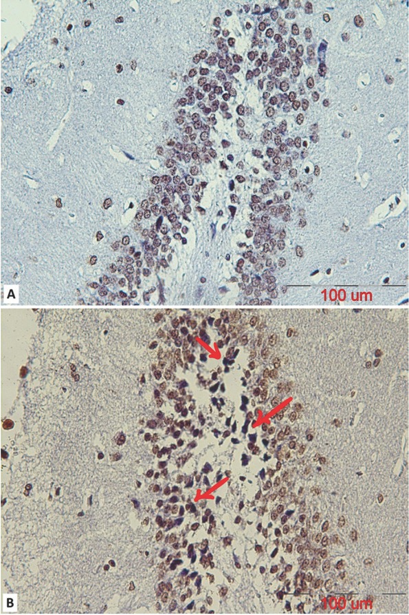 Figure 5 A representative coronal section of the DG part of a mature male rat’s hippocampus stained using a TUNEL assay to observe apoptotic cells in (A) control and (B) stanozolol treated groups. The arrows indicate TUNEL positive cells with dark brown nuclei (scalebar=100μm).