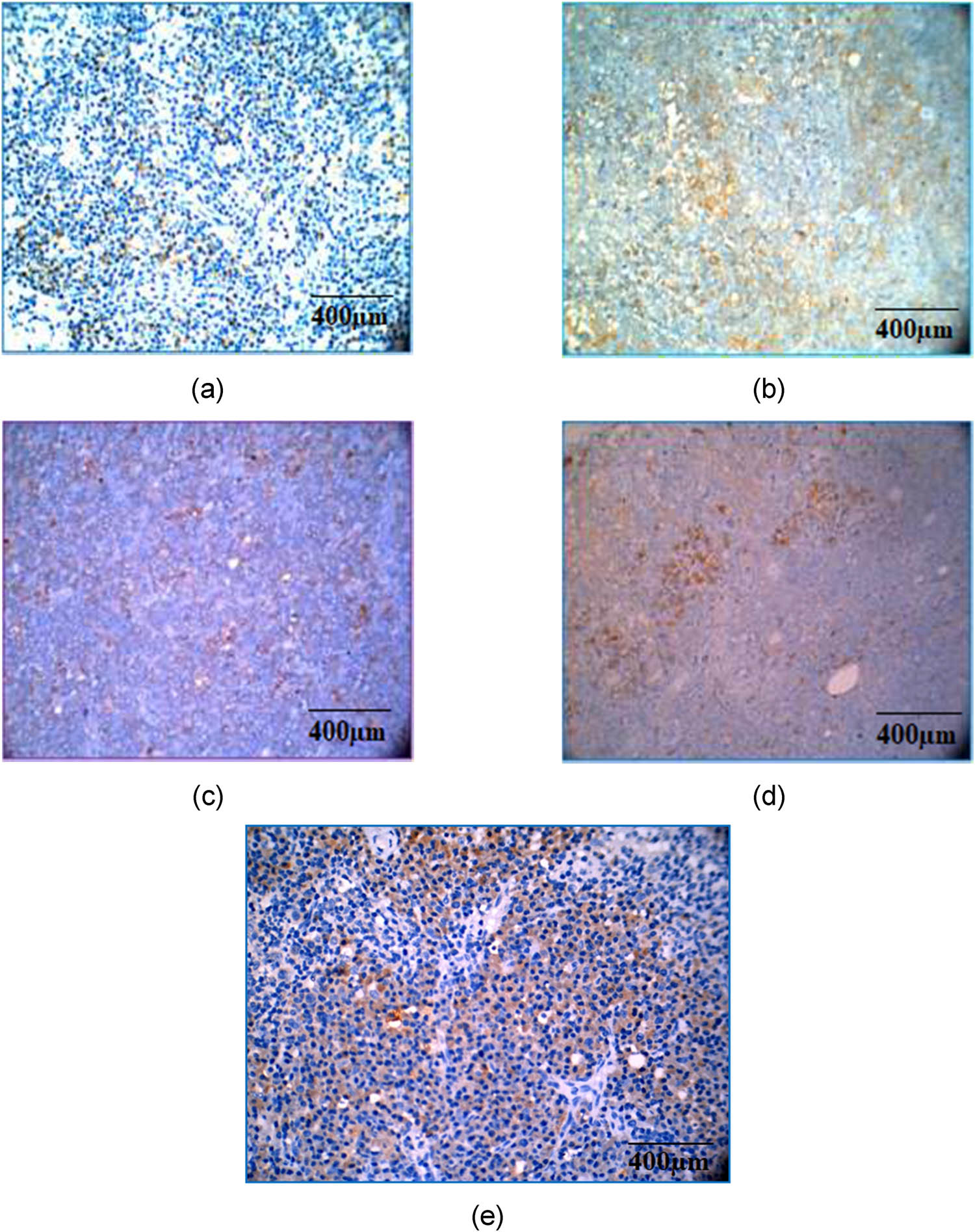 Figure 11 
                  Immunohistochemical analysis of TNF-α by hematoxylin and eosin staining. Magnification and scale bar: 40× corresponds to 400 µm of different experimental groups. (a) Normal control; (b) arthritic control showing a marked expression; (c) methotrexate control showing a moderate expression; (d) CSP (5 mg/kg) showing a mild expression; and (e) CSP (10 mg/kg) showing a mild expression.
               