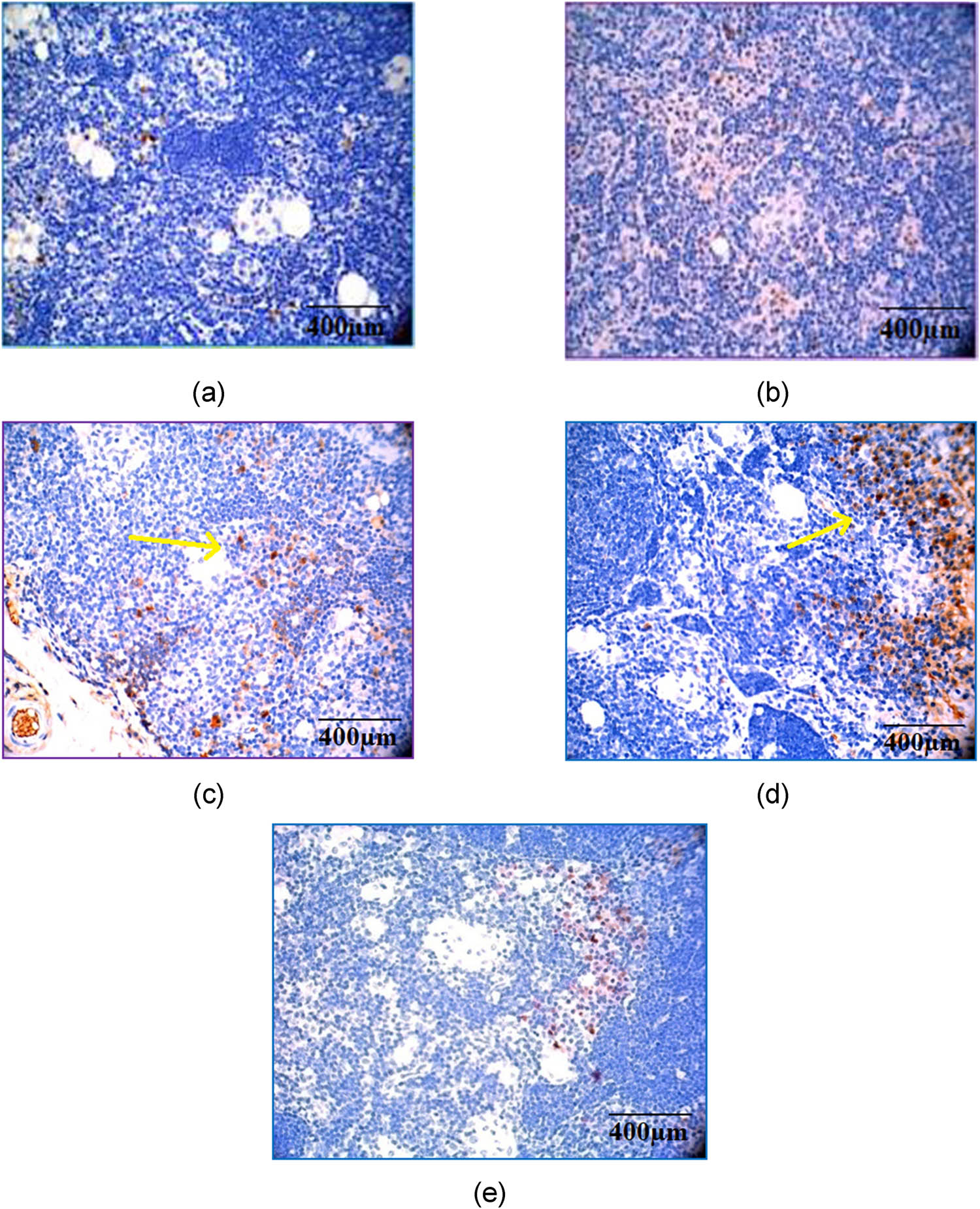 Figure 12 
                  Immunohistochemical analysis of TGF-β by hematoxylin and eosin staining. Magnification and scale bar: 40× corresponds to 400 µm of different experimental groups. (a) Normal control; (b) arthritic control; (c) methotrexate control showing a moderate expression; (d) CSP (5 mg/kg) showing a marked expression; and (e) CSP (10 mg/kg) showing a mild expression.
               