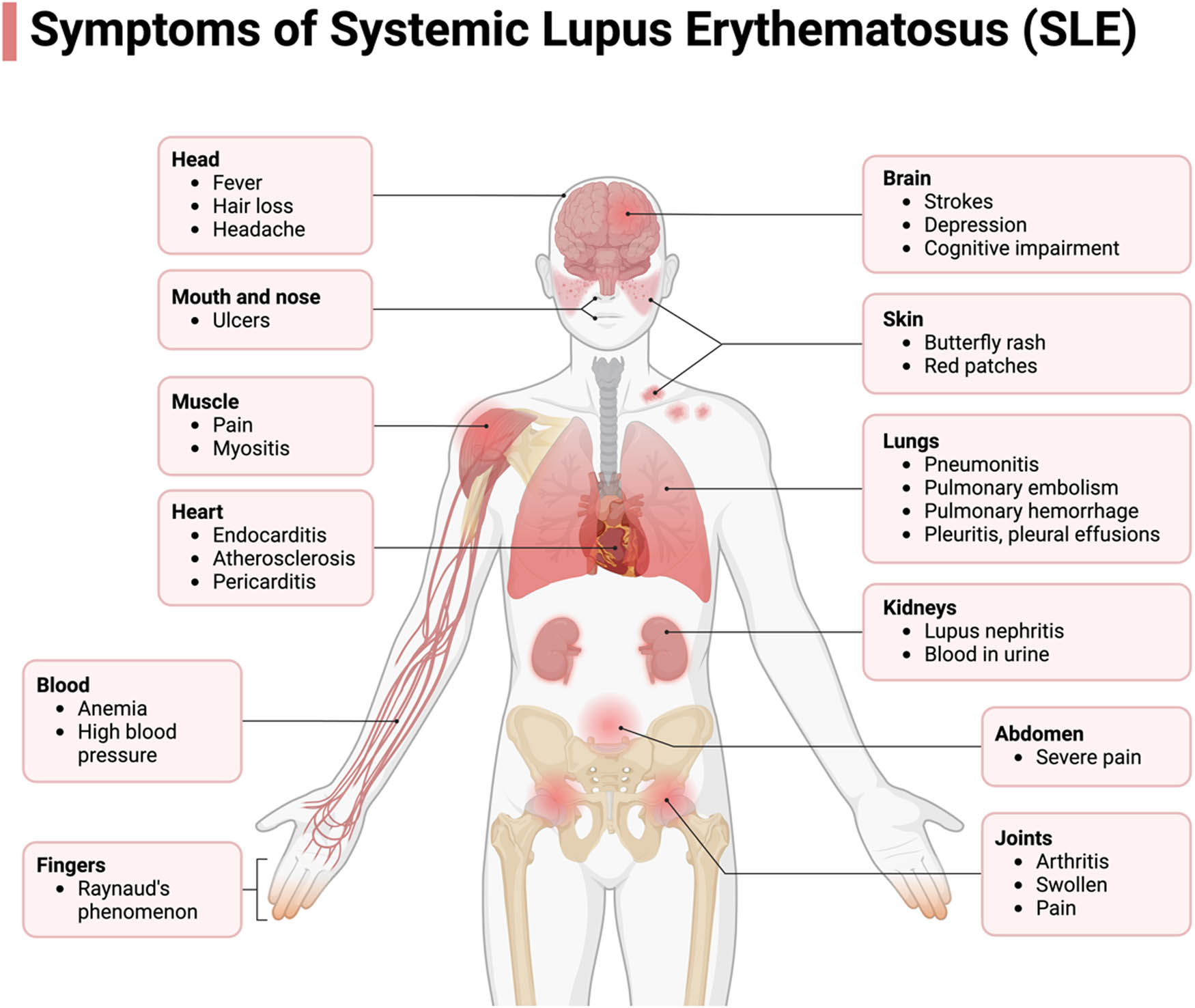 Figure 2
The Systemic Manifestations of SLE. SLE encompass a wide range of pathological presentations, stemming from its autoimmune nature. This condition exerts its impact across multiple organs, inducing dysfunction. SLE can give rise to a spectrum of complications affecting the nervous system, cardiovascular system, hematological system, pulmonary system, renal function, joints, mucosal membranes, and the integumentary system, as depicted in the accompanying figure. Certain manifestations bear greater clinical significance, notably those involving the renal, hematological, and neurological systems, which can lead to profound consequences such as renal failure, chronic anemia, and psychosis in afflicted patients.