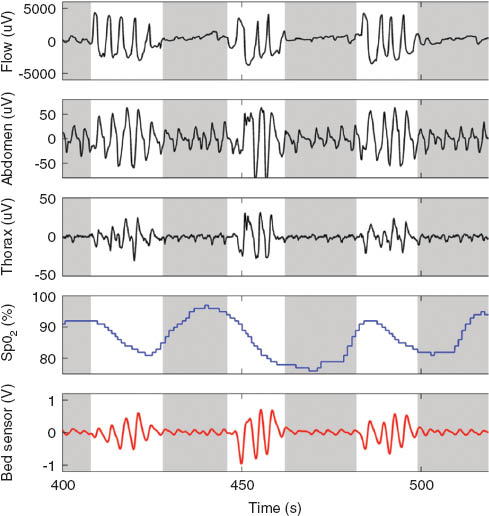 Figure 13 Example BCG bed sensor measurements from the sleep apnea study. From top to bottom: PSG references (flow, abdominal effort, thoracic effort, SpO2), BCG bed sensor. Gray shaded epochs show apnea.