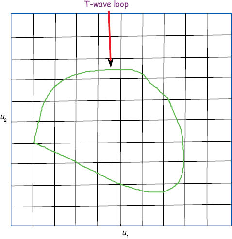 Figure 5: Percentage of loop area (PL).Projection of T-wave loop on u1 and u2 planes.